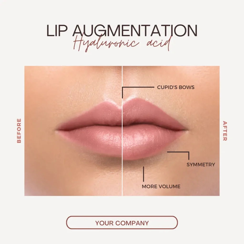 Lip augmentation before-and-after comparison showing improved volume, cupid’s bow definition, and symmetry.
